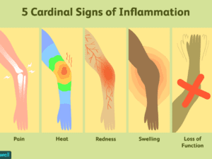A diagram of the five cardinal signs of inflammation.